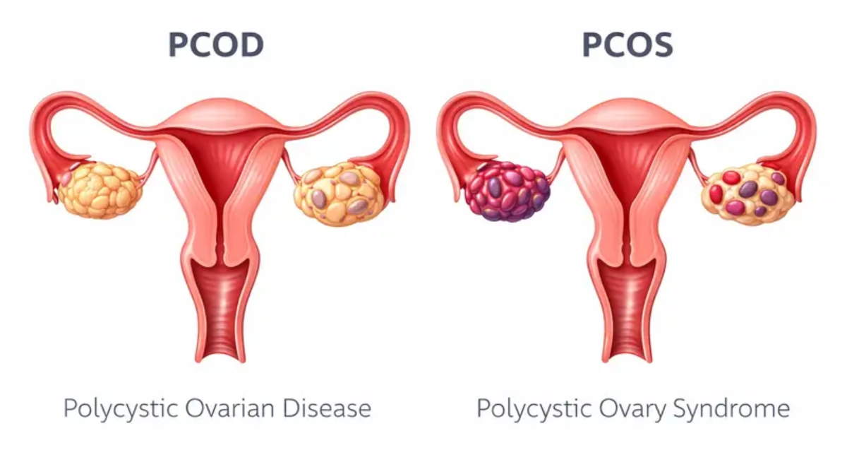 PCOD vs PCOS: What's the Difference? Symptoms, Causes & Treatment